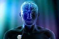 Deep Brain Stimulation