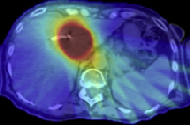 Dosing for Organ Motion