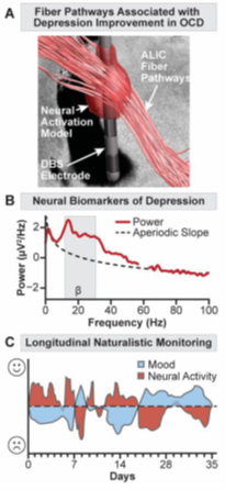 Chart depicting fiber pathways associated with depression improvement in OCD
